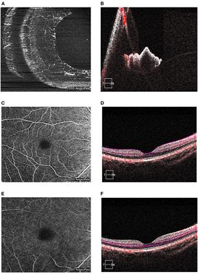 Quantitative changes in iris and retinal blood flow after femtosecond laser-assisted in situ keratomileusis and small-incision lenticule extraction